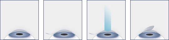 LASIK Chart